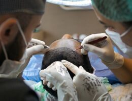Undgå dyre priser og få fantastiske resultater: Hårtransplantation i Tyrkiet