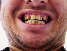 invisalign pris